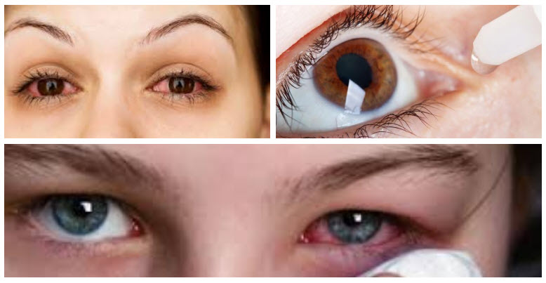 علاج-حساسية-العين.-الدليل-الشامل-الأسباب-–-الاعراض-–-التشخيص